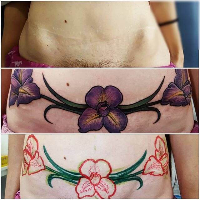 A three-photo collage showing the progression of a tattoo cover-up over a surgical scar on a torso. The bottom image shows the initial design, the middle image shows the outline, and the top image shows the finished tattoo.