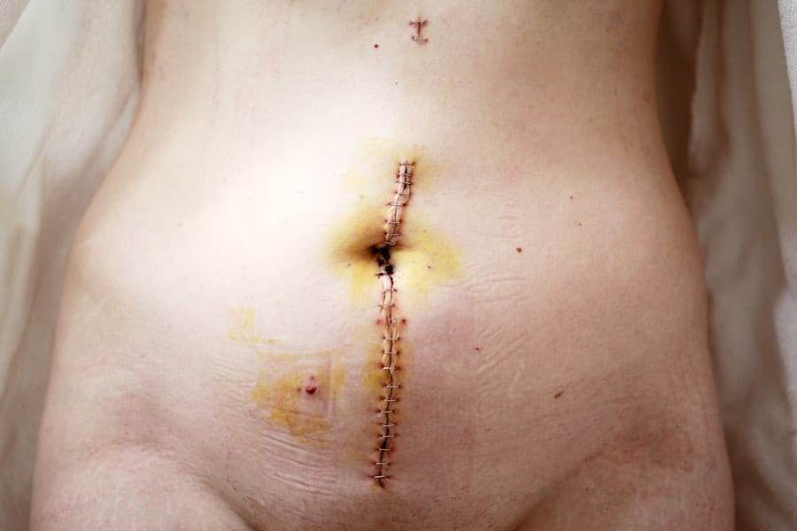 An abdomen showing a vertical surgical incision held together with staples, surrounded by bruising.