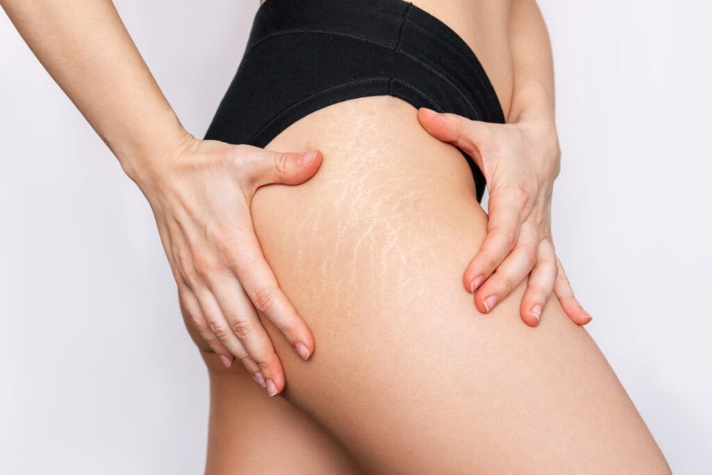Person touching their thigh with visible stretch marks on the skin.