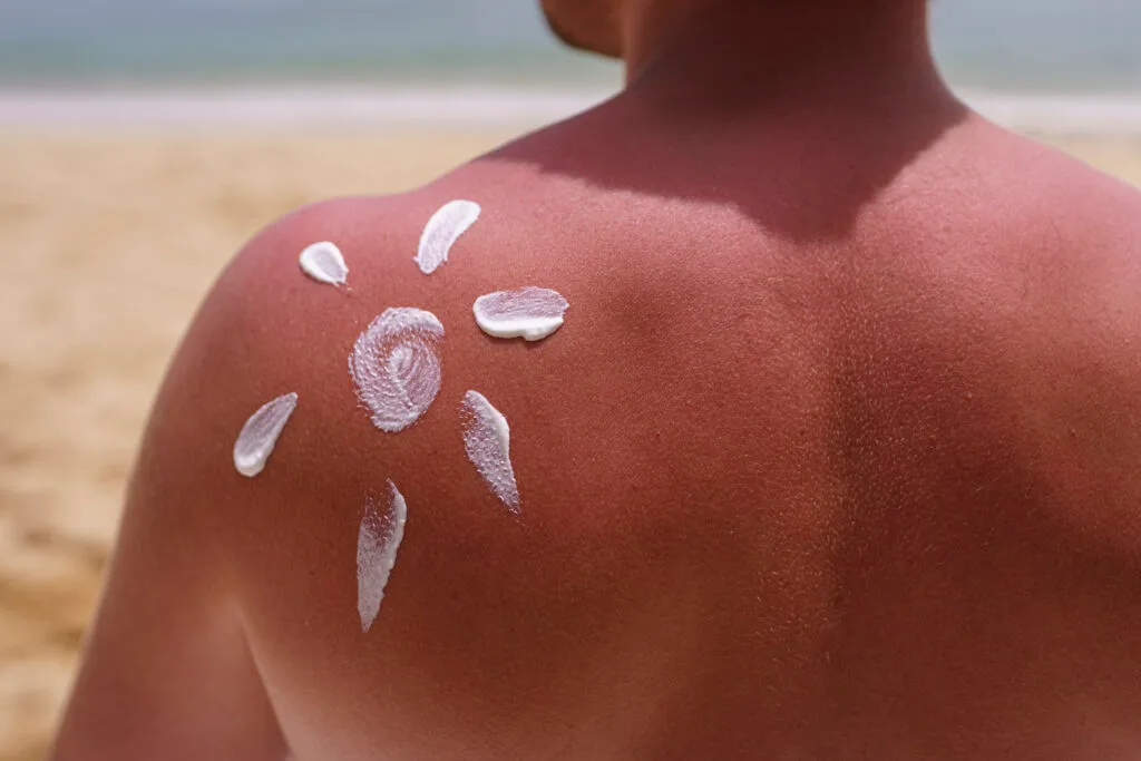 Back of a person’s shoulder with white sunscreen applied in a sunburst pattern, on a beach.