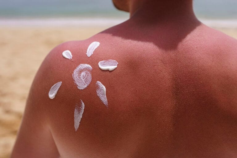 A person with a sunburned back has sunscreen applied in the shape of a sun; the beach and ocean are visible in the background.